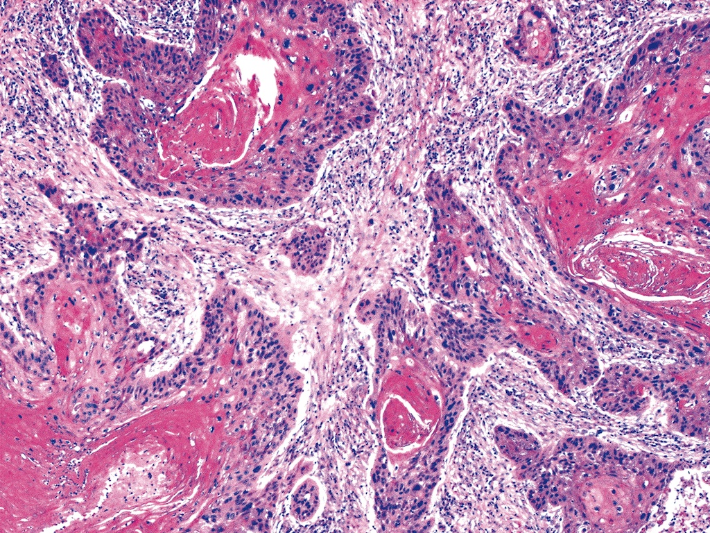 esophageal-squamous-cell-carcinoma-histology